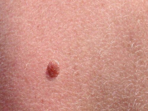 skin moles to worry about