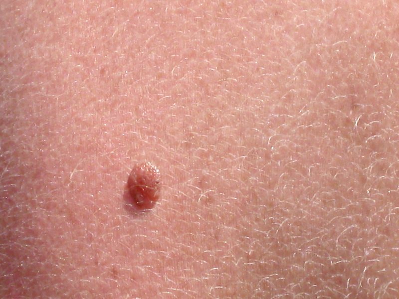 Should I Be Worried About The Moles On My Skin? - HodgePodgeDays